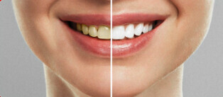 Clareamento Dental